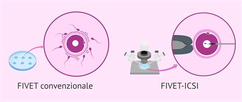 infografica che illustra la differenza tra fecondazione naturale, FIVET e ICSI