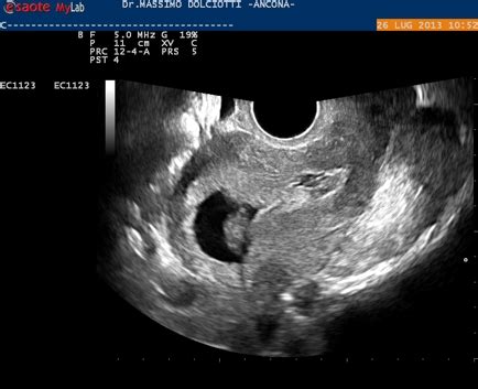 Ecografia di distacco placentare lieve