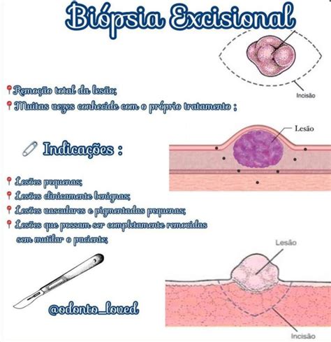 Tipi di biopsia: incisionale, escissionale, agobiopsia