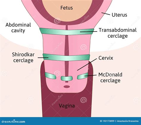 rappresentazione schematica dell'utero e del cerchiaggio cervicale