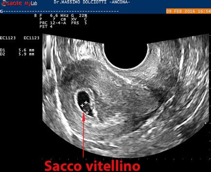 rappresentazione ecografica del sacco vitellino nella camera gestazionale