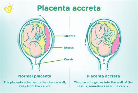 confronto visivo tra placenta normale e placenta accreta