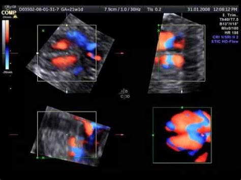 Cuore fetale in 4D con tecnica STIC
