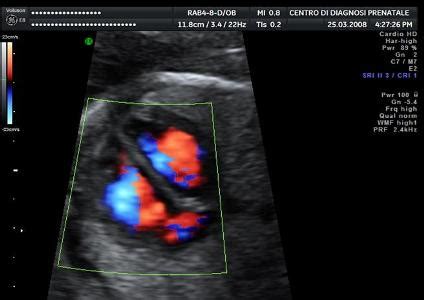 Limiti diagnostici ecocardiografia fetale