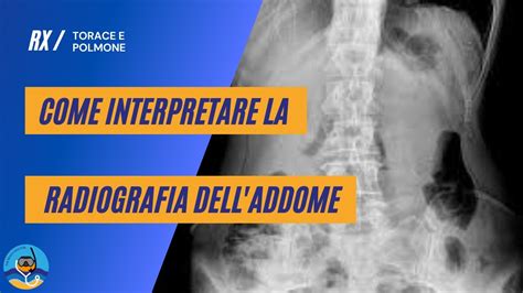 confronto tra immagini radiografiche standard e TAC addominale che evidenzia gli ovuli di droga