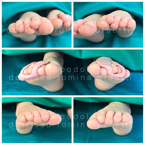 confronto tra dita normali e dita con clinodattilia