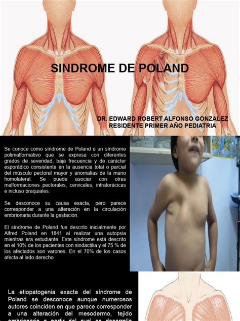 illustrazione clinica della sindrome di poland unilaterale