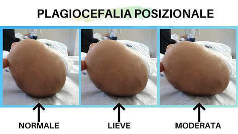 grafico che illustra la differenza tra una testa simmetrica e una testa con plagiocefalia posizionale