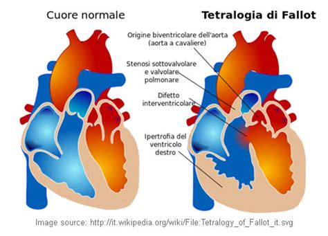 Schema della Tetralogia di Fallot
