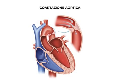 Rappresentazione della Coartazione Aortica