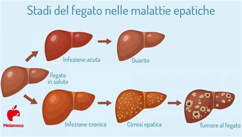 Evoluzione epatite cronica HCV