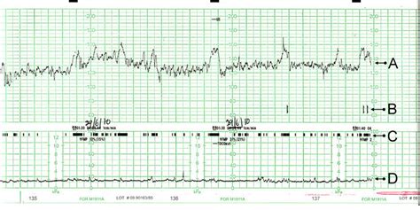 Cardiotocografia fetale